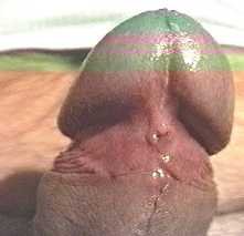 pr�puce circoncis, frein coup�