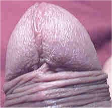 pr�puce non coup�, frein sectionn�