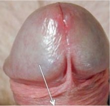 frein non coup� 2
