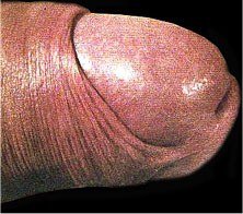 frein et pr�puce non coup�s